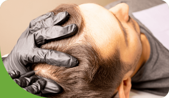 Hair Restoration Marketing 1 Digital Marketing for Hair Transplant & Restoration practices